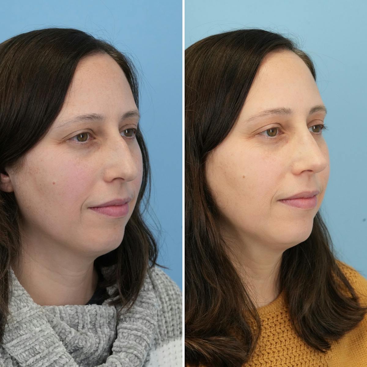Rhinoplasty Before & After Gallery - Patient 237232 - Image 3