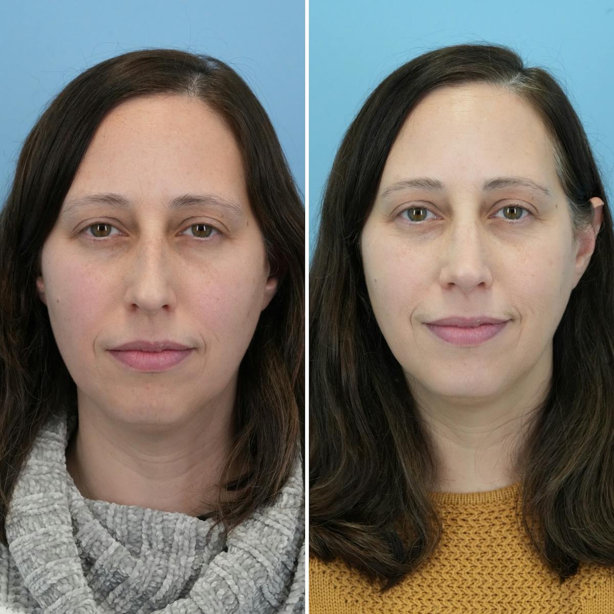 Rhinoplasty Before & After Gallery - Patient 237232 - Image 4