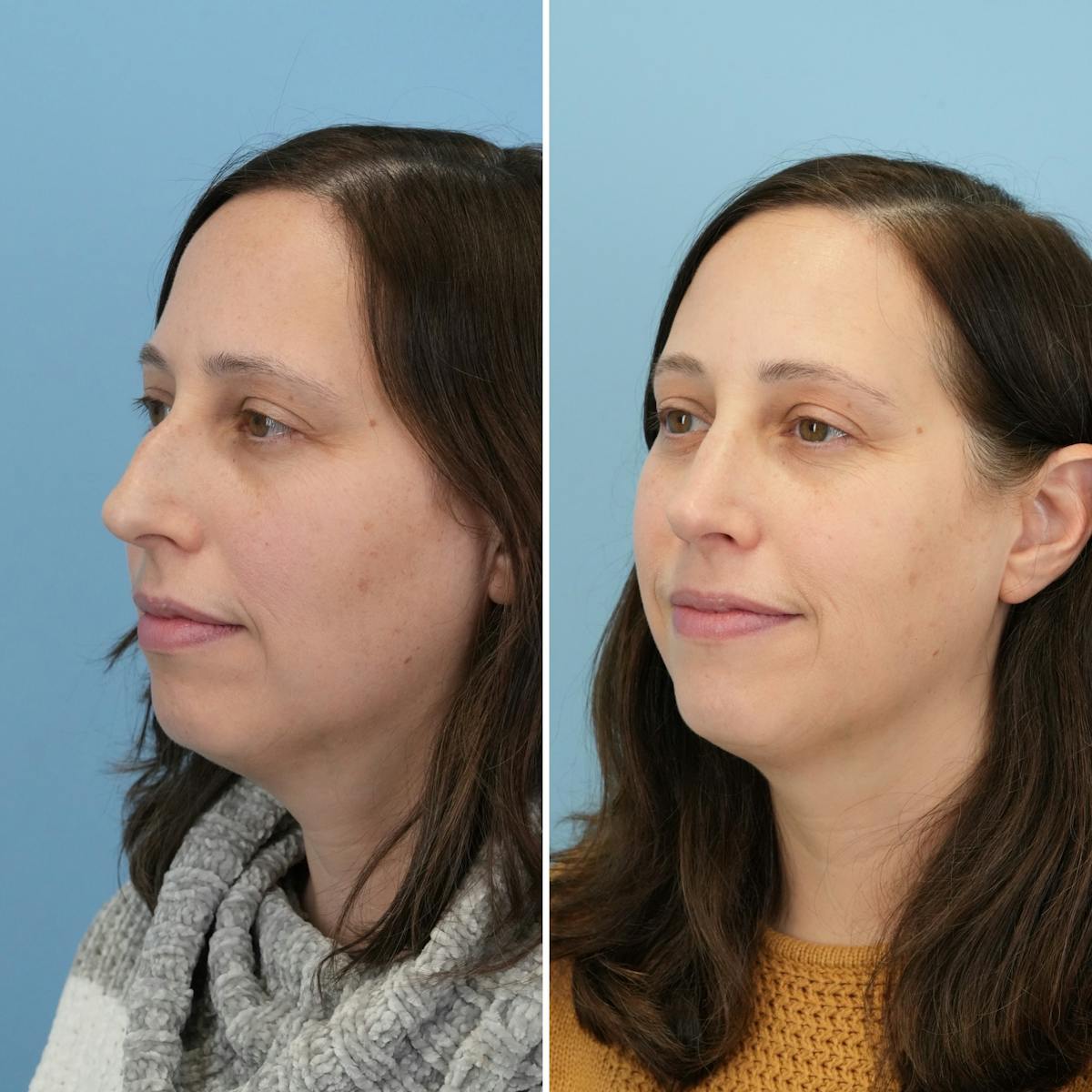 Rhinoplasty Before & After Gallery - Patient 237232 - Image 5