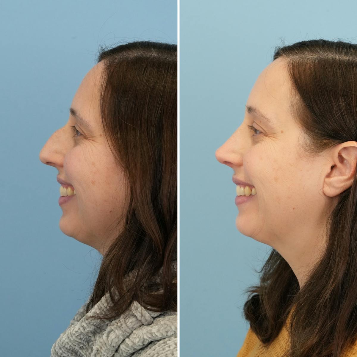 Rhinoplasty Before & After Gallery - Patient 237232 - Image 6