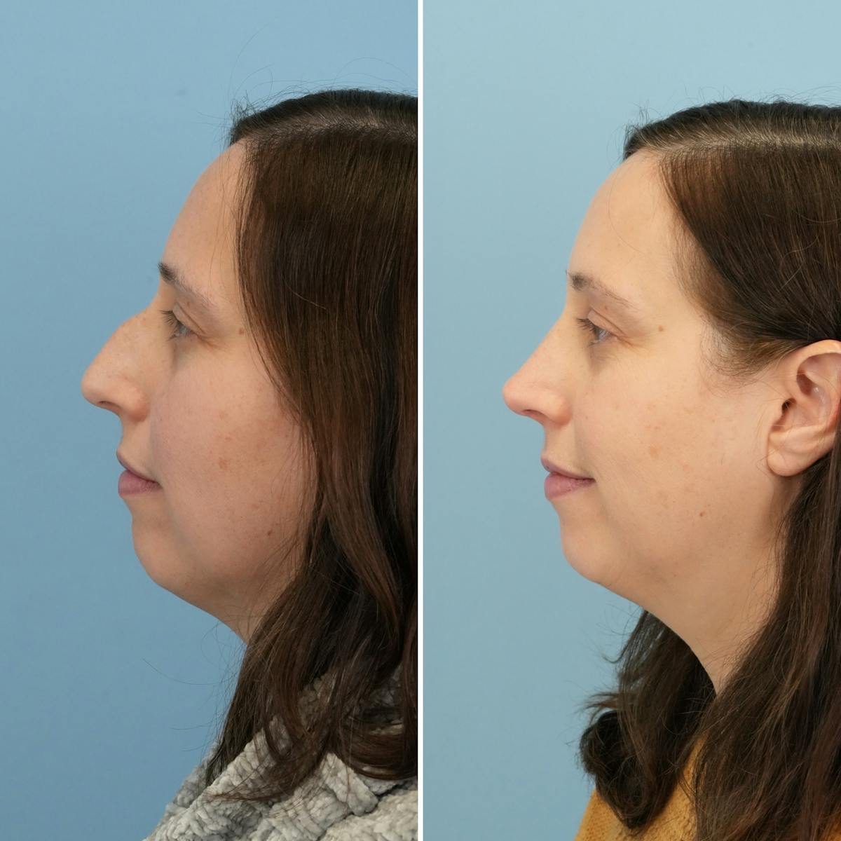 Rhinoplasty Before & After Gallery - Patient 237232 - Image 7