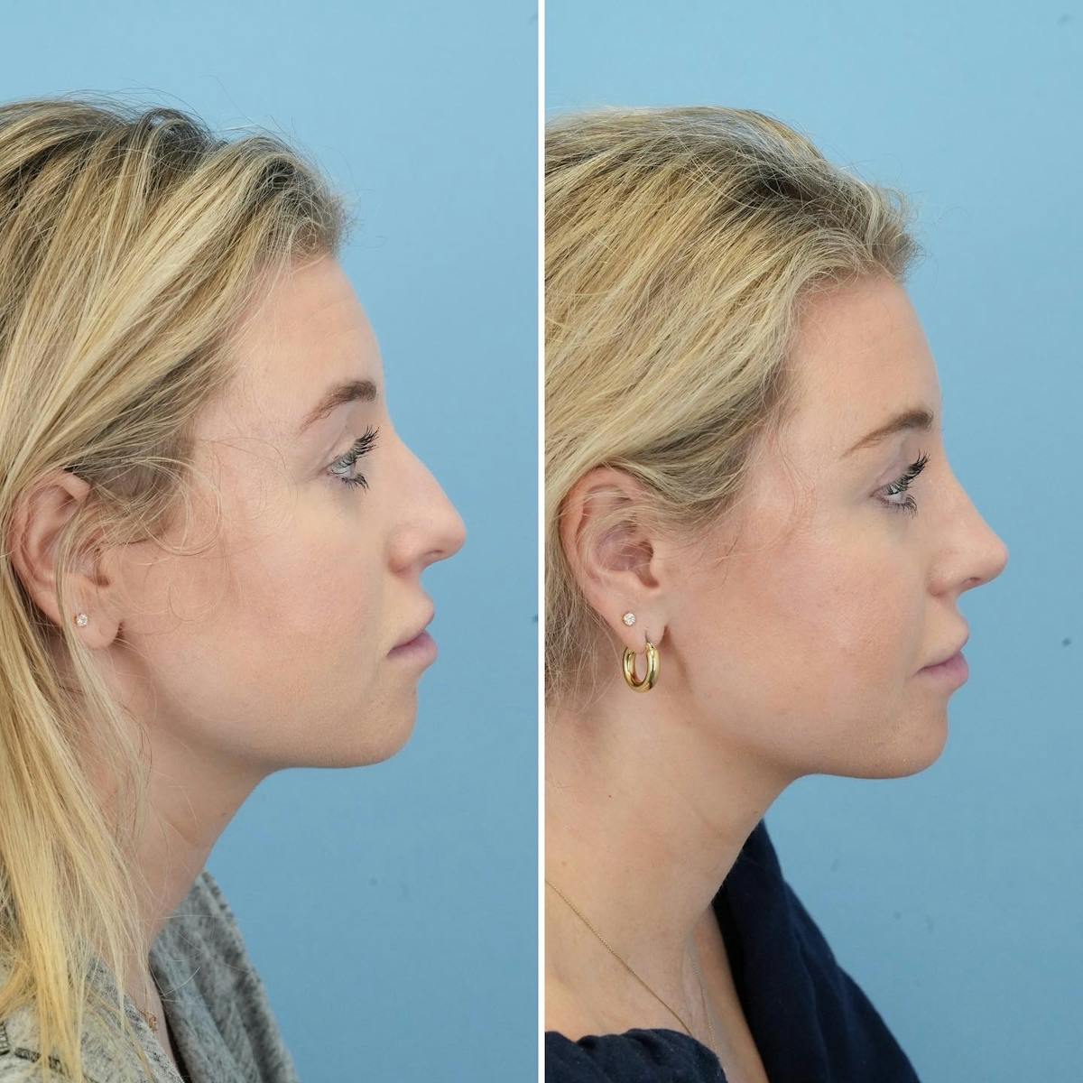 Rhinoplasty Before & After Gallery - Patient 382800 - Image 1