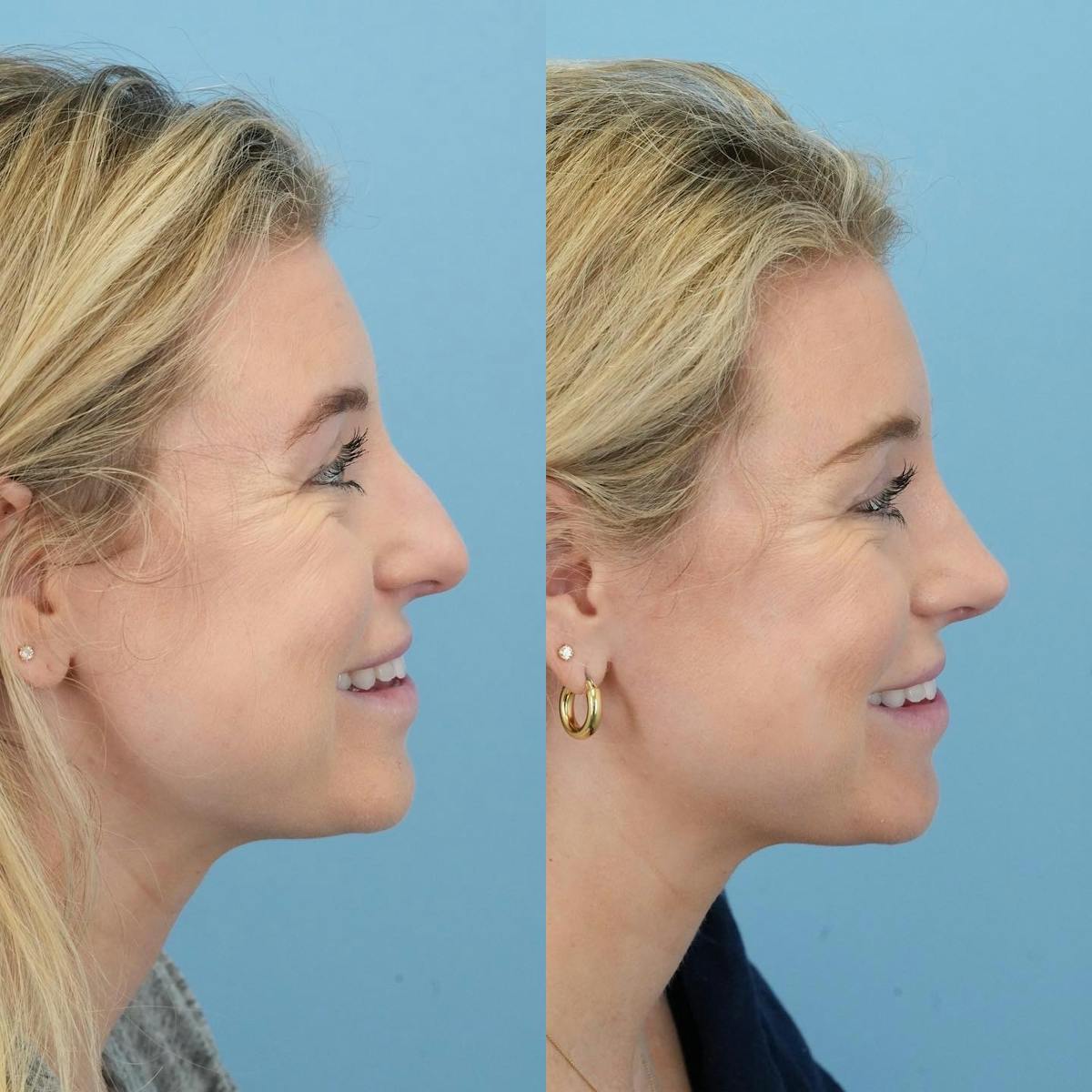 Rhinoplasty Before & After Gallery - Patient 382800 - Image 2