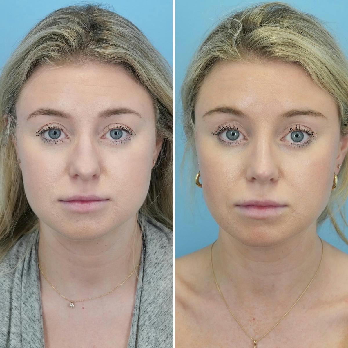 Rhinoplasty Before & After Gallery - Patient 382800 - Image 3