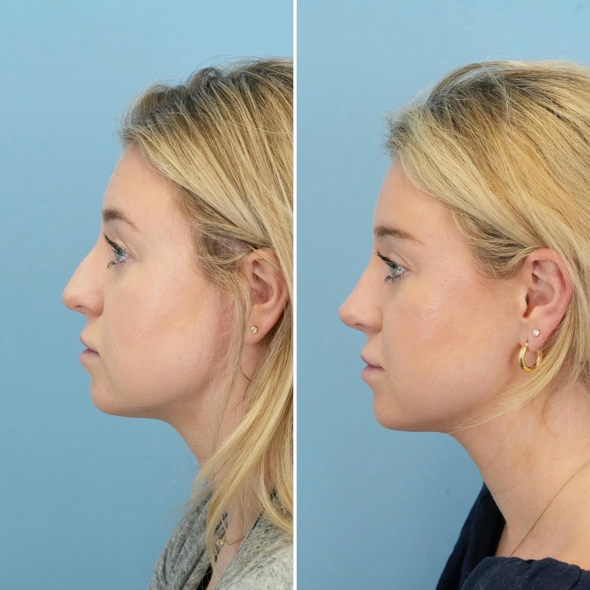 Rhinoplasty Before & After Gallery - Patient 382800 - Image 5