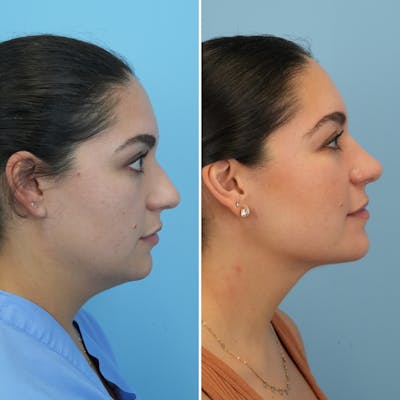 Rhinoplasty Before & After Gallery - Patient 862281 - Image 1