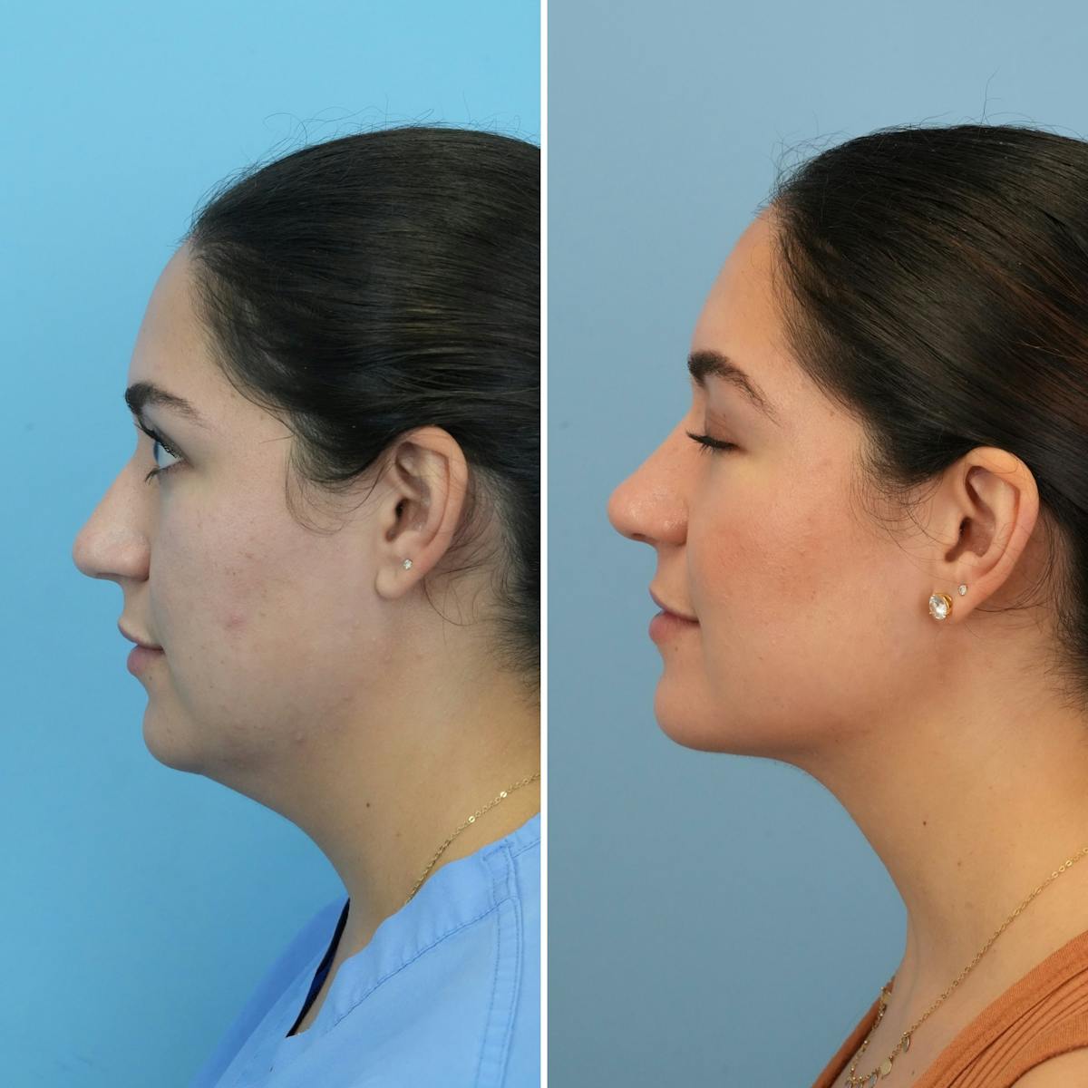 Rhinoplasty Before & After Gallery - Patient 862281 - Image 3