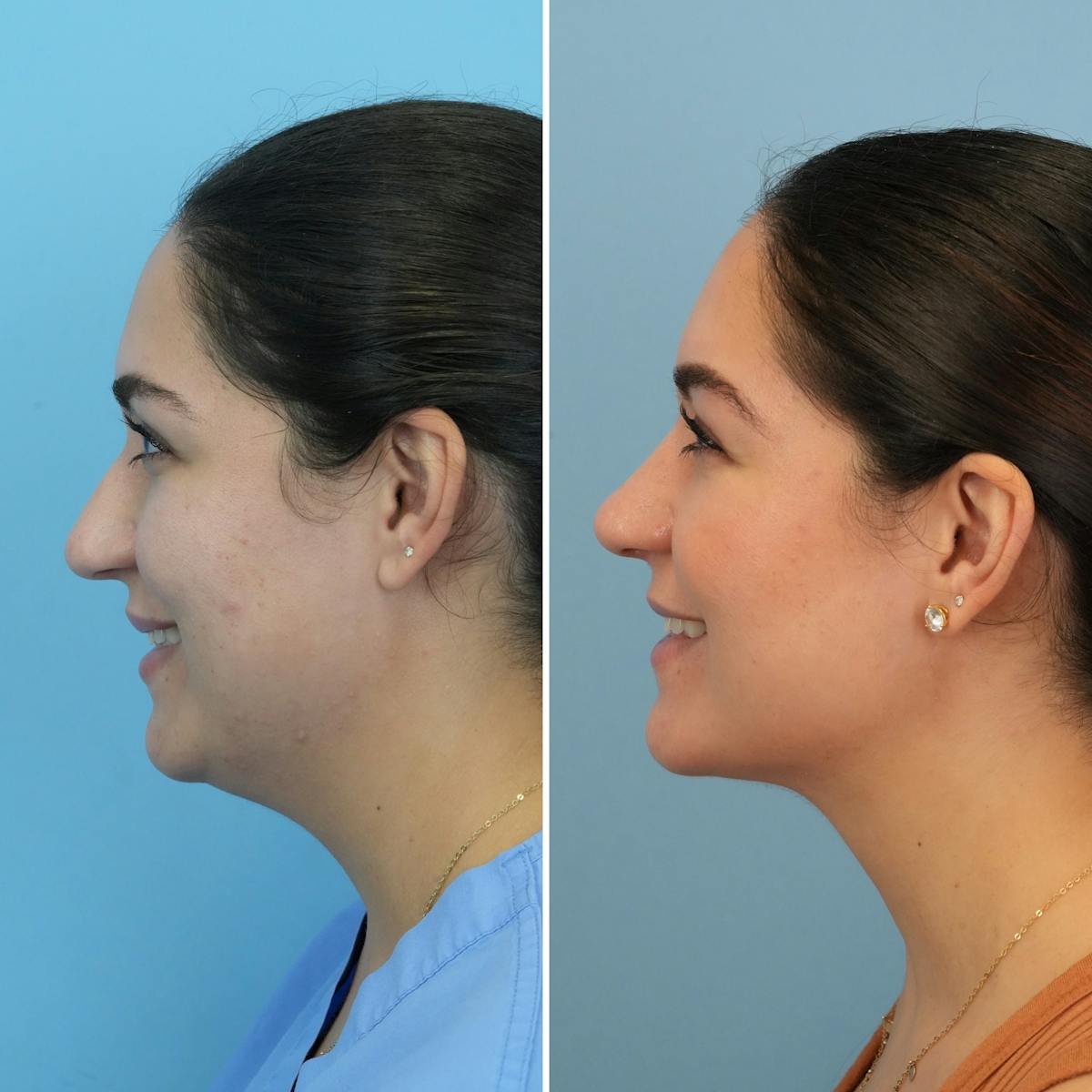 Rhinoplasty Before & After Gallery - Patient 862281 - Image 4