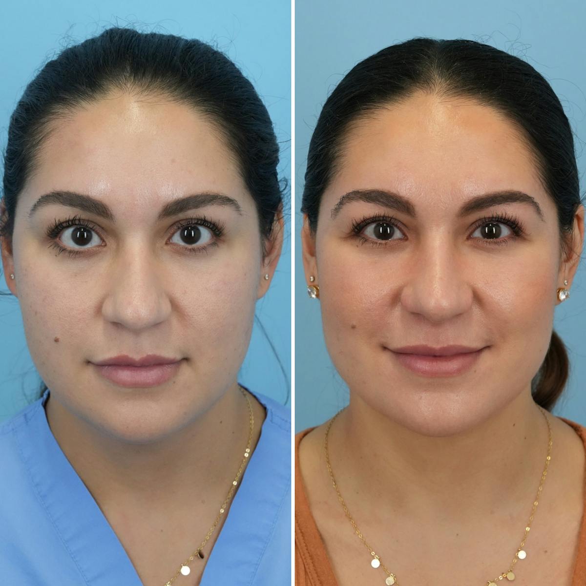 Rhinoplasty Before & After Gallery - Patient 862281 - Image 5