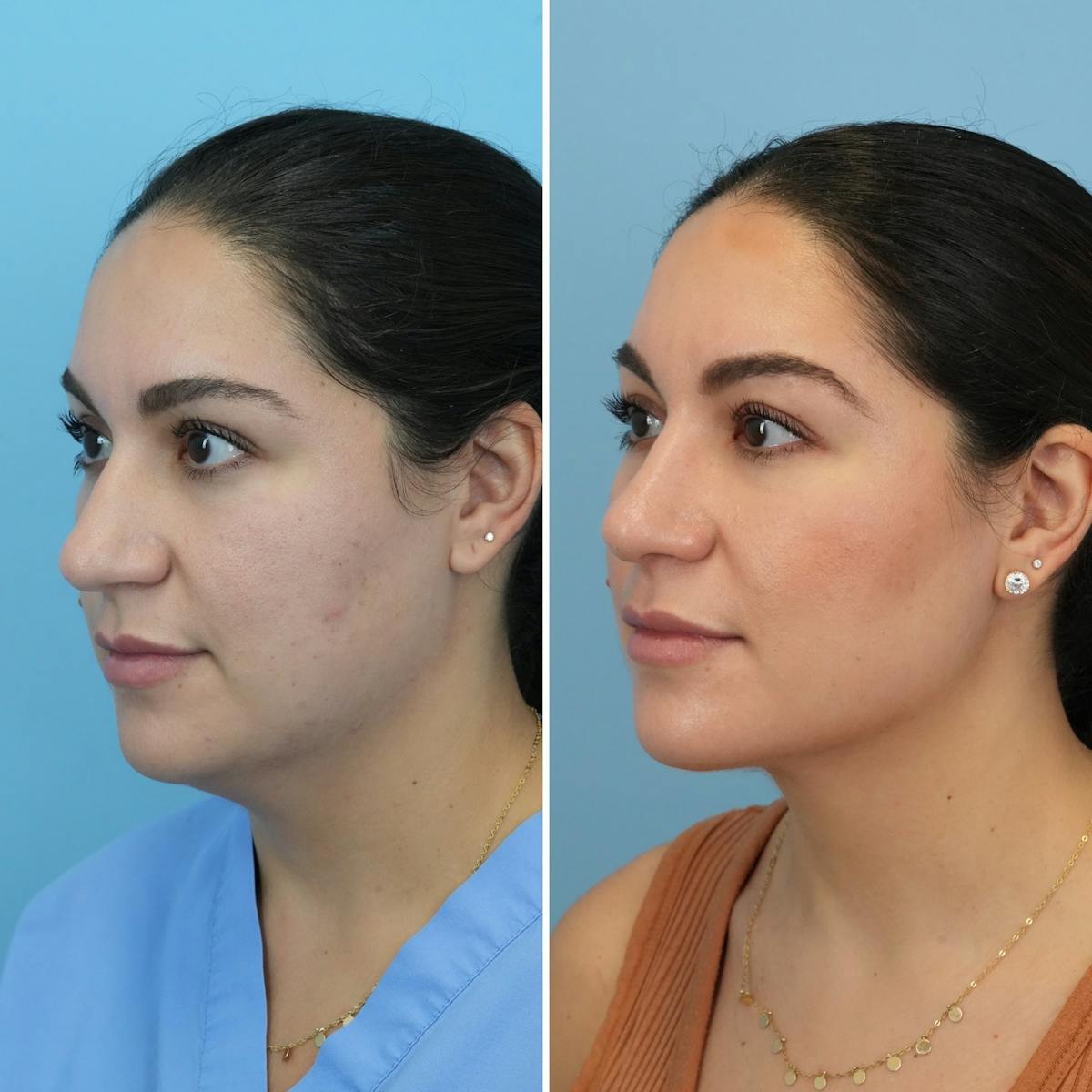 Rhinoplasty Before & After Gallery - Patient 862281 - Image 6