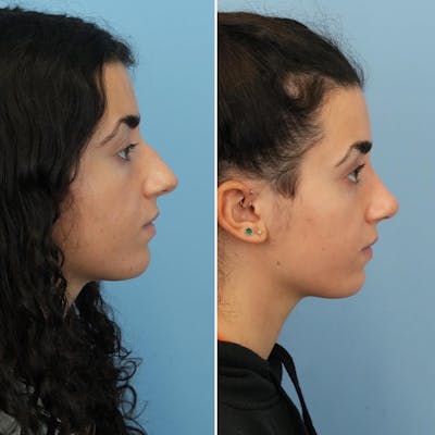 Rhinoplasty Before & After Gallery - Patient 281400 - Image 1