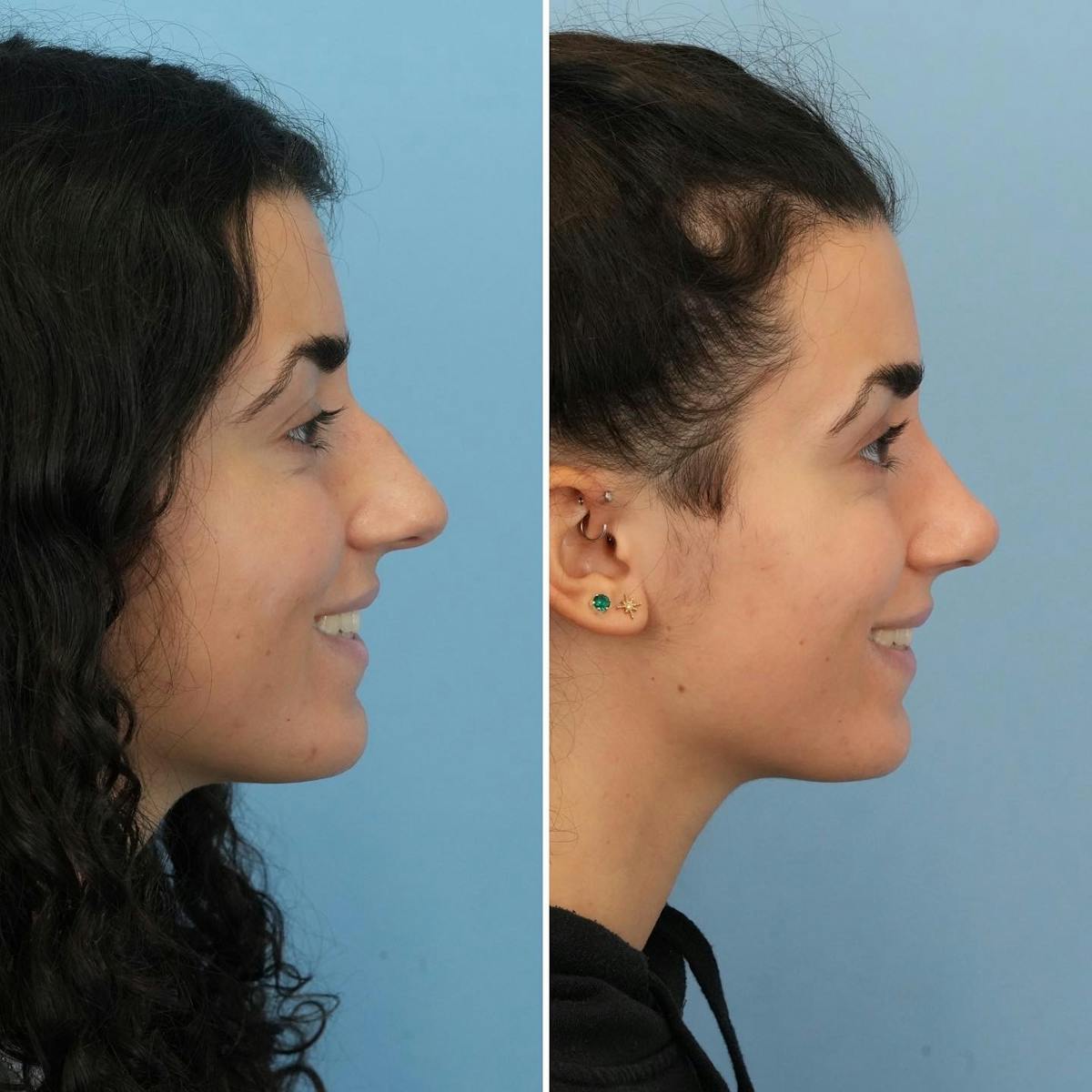 Rhinoplasty Before & After Gallery - Patient 281400 - Image 2