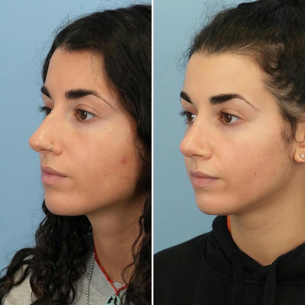 Rhinoplasty Before & After Gallery - Patient 281400 - Image 3