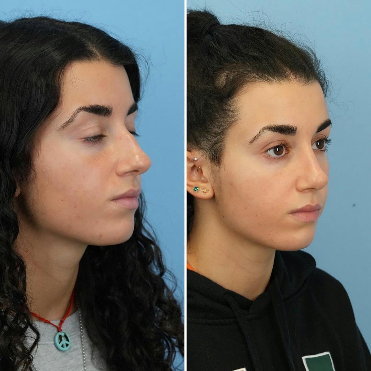 Rhinoplasty Before & After Gallery - Patient 281400 - Image 4