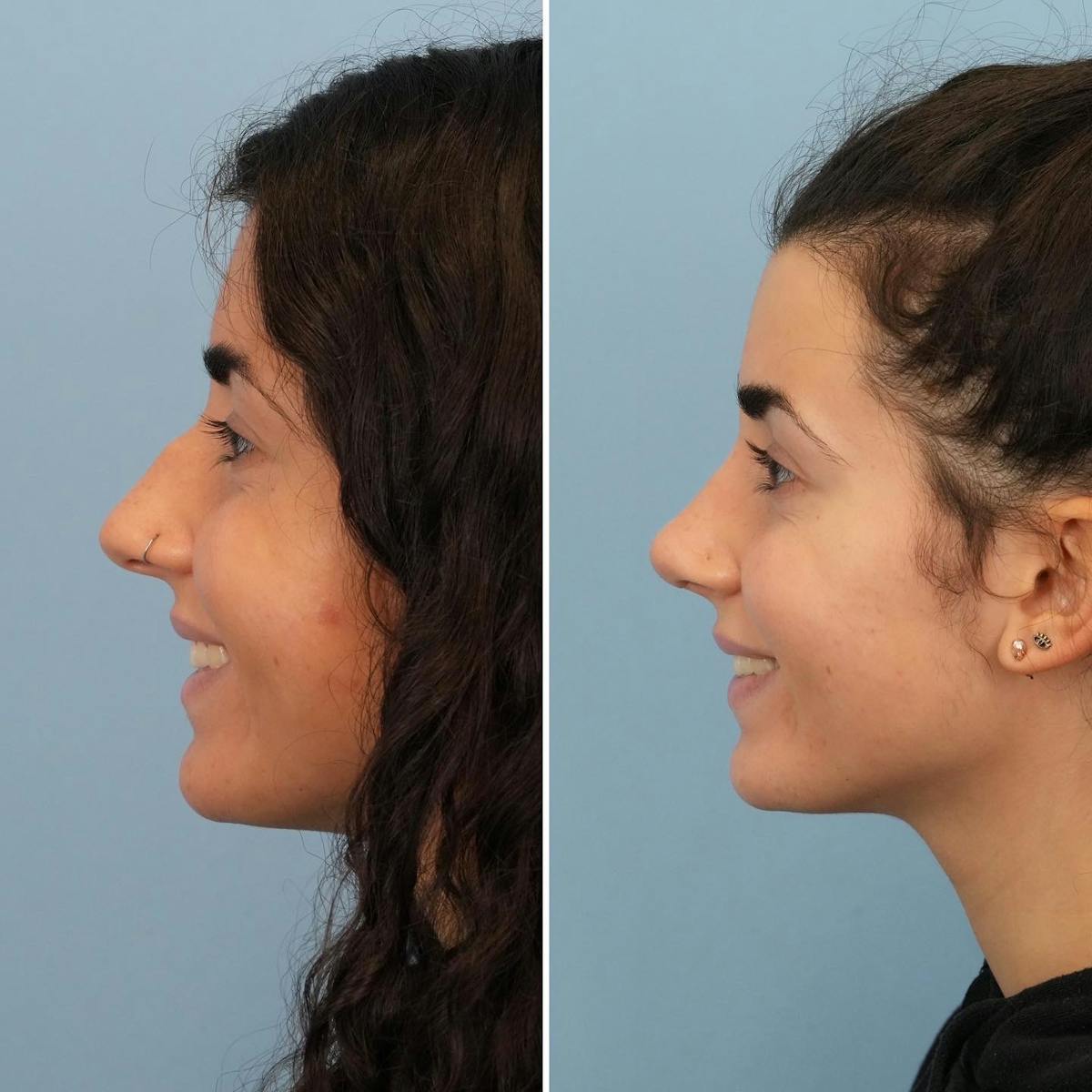 Rhinoplasty Before & After Gallery - Patient 281400 - Image 6