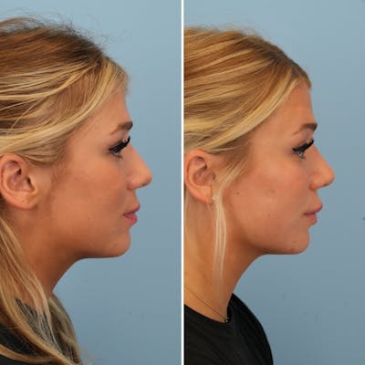Rhinoplasty Before & After Gallery - Patient 194611 - Image 1