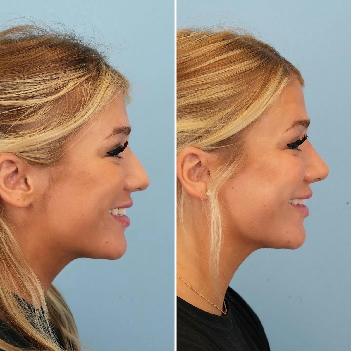 Rhinoplasty Before & After Gallery - Patient 194611 - Image 2