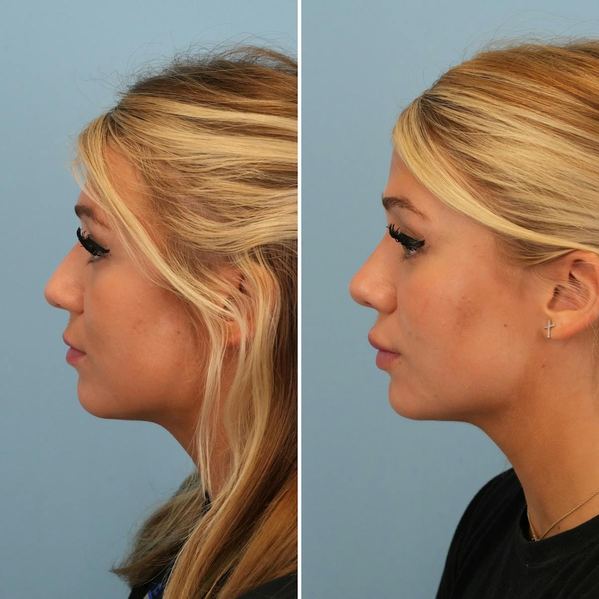 Rhinoplasty Before & After Gallery - Patient 194611 - Image 3