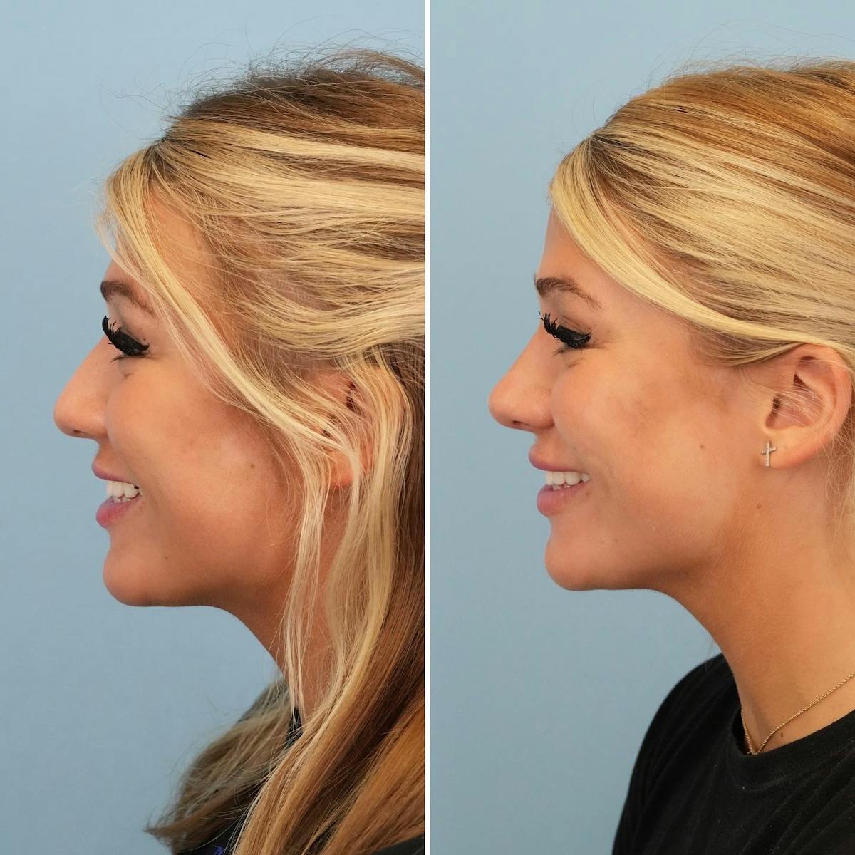 Rhinoplasty Before & After Gallery - Patient 194611 - Image 5