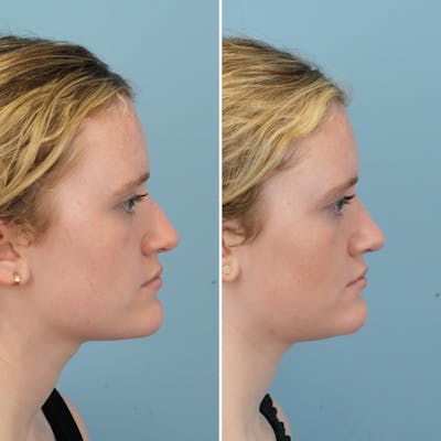 Rhinoplasty Before & After Gallery - Patient 109542 - Image 1