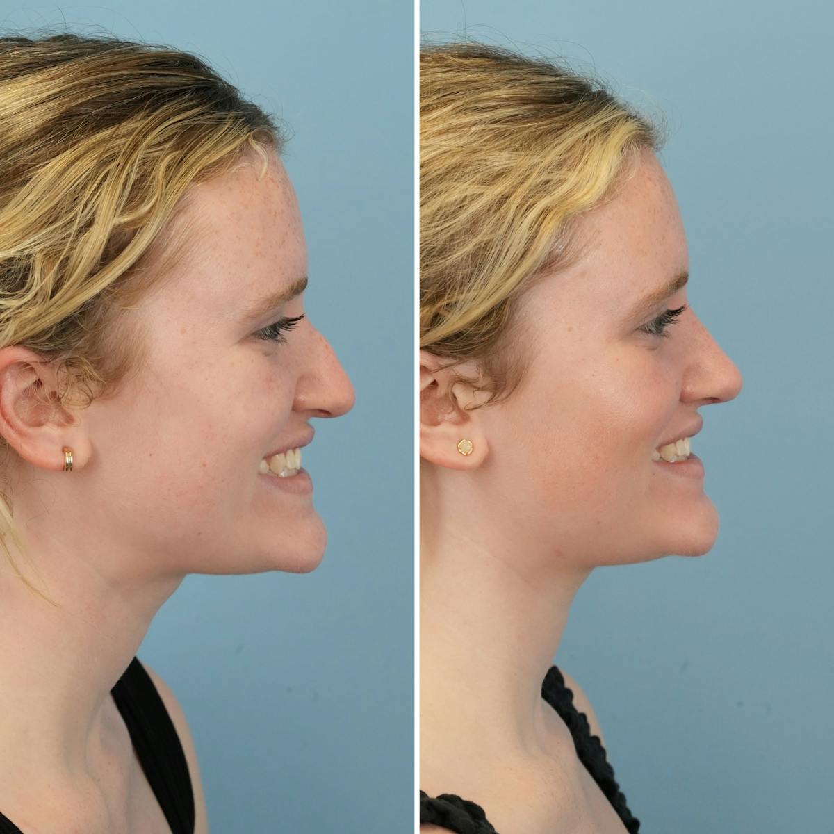 Rhinoplasty Before & After Gallery - Patient 109542 - Image 2