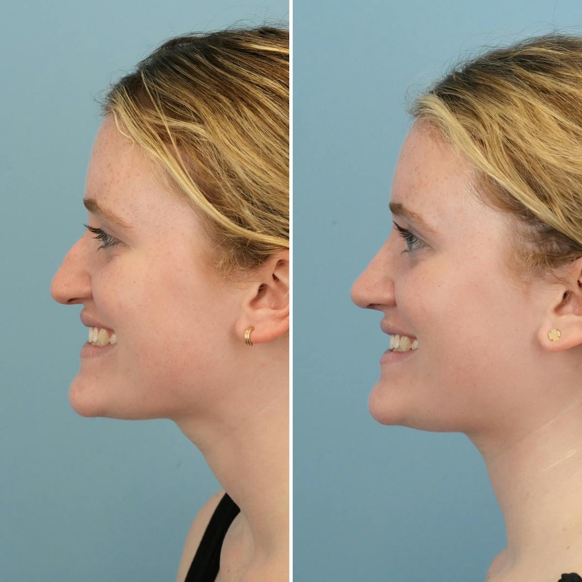 Rhinoplasty Before & After Gallery - Patient 109542 - Image 3