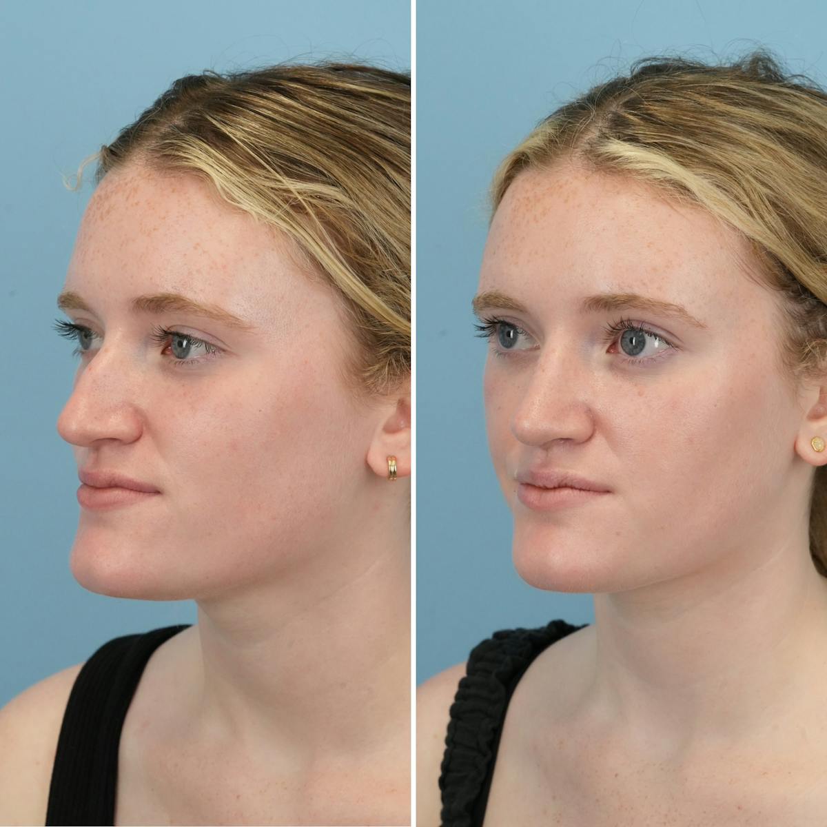 Rhinoplasty Before & After Gallery - Patient 109542 - Image 4