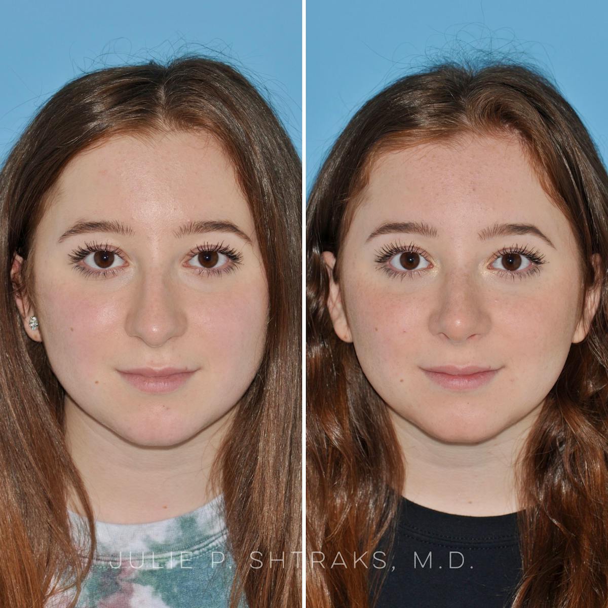 Rhinoplasty Before & After Gallery - Patient 204110 - Image 3