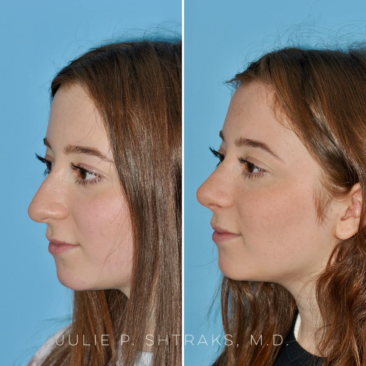 Rhinoplasty Before & After Gallery - Patient 204110 - Image 4