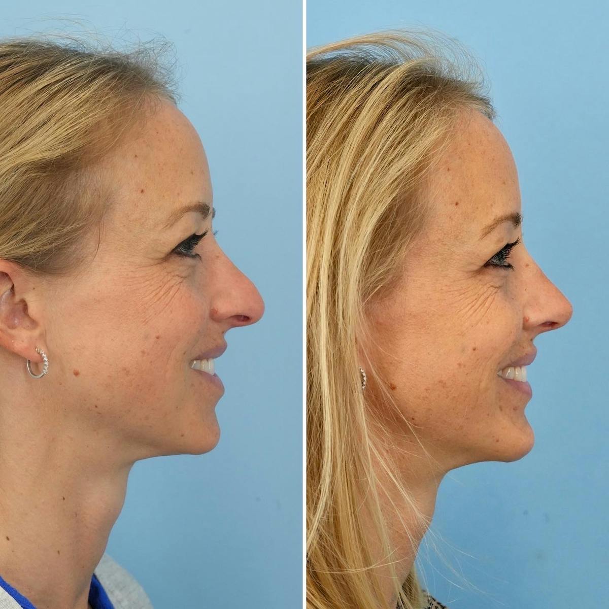 Rhinoplasty Before & After Gallery - Patient 339282 - Image 2