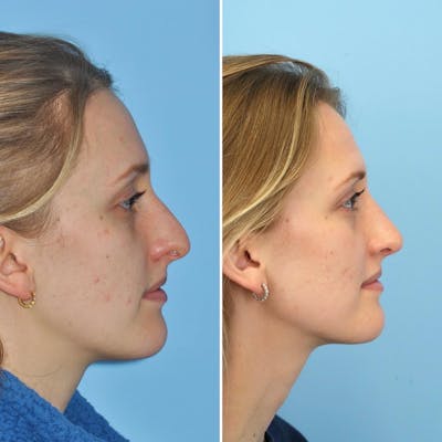 Rhinoplasty Before & After Gallery - Patient 110830 - Image 1