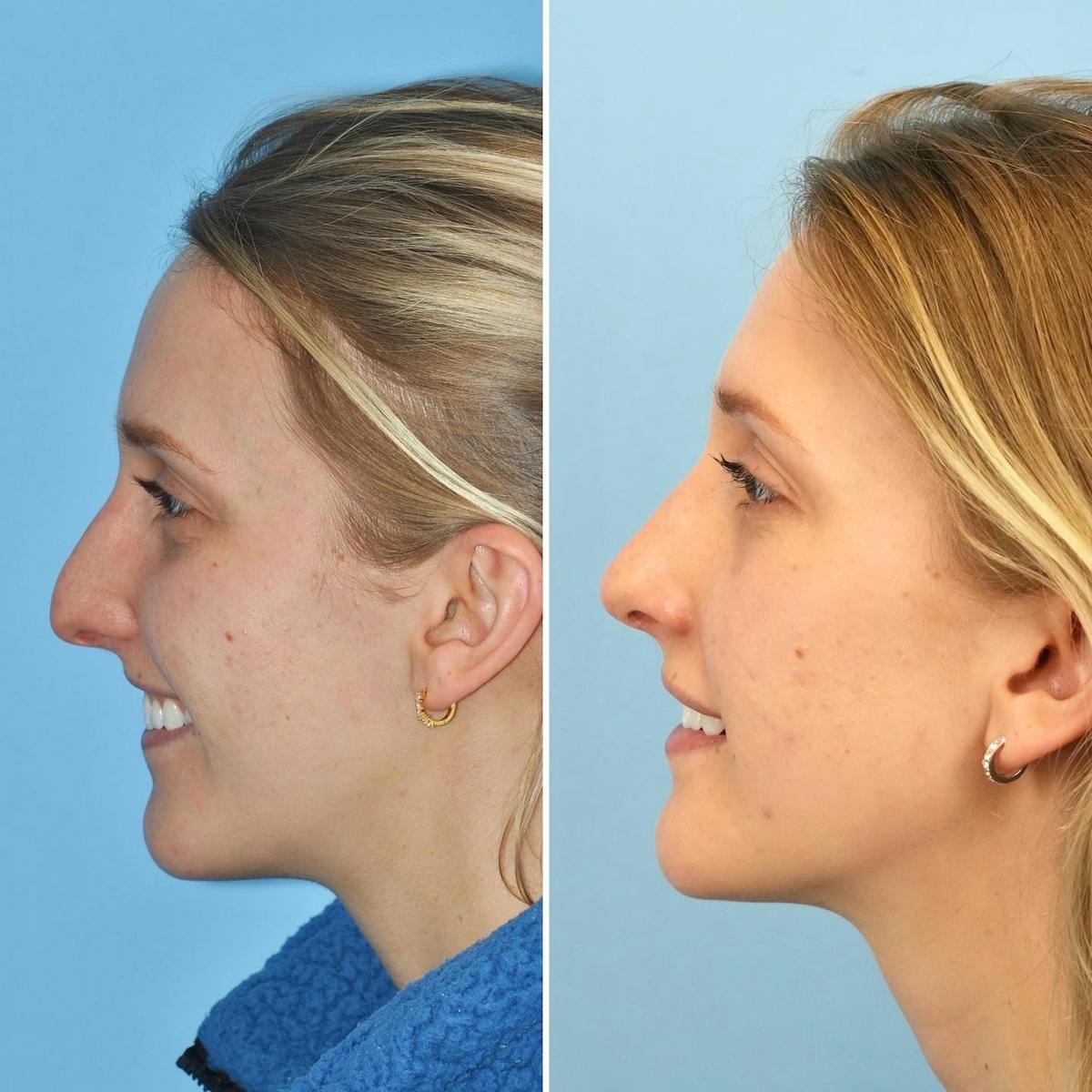 Rhinoplasty Before & After Gallery - Patient 110830 - Image 4