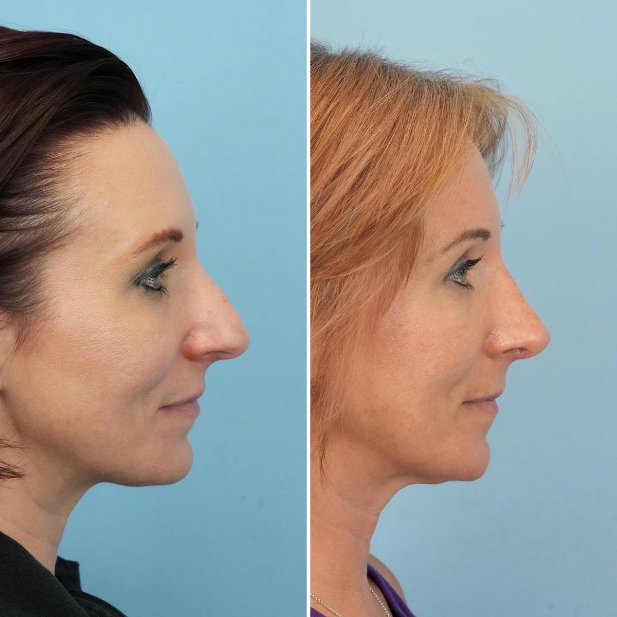 Rhinoplasty Before & After Gallery - Patient 338299 - Image 1