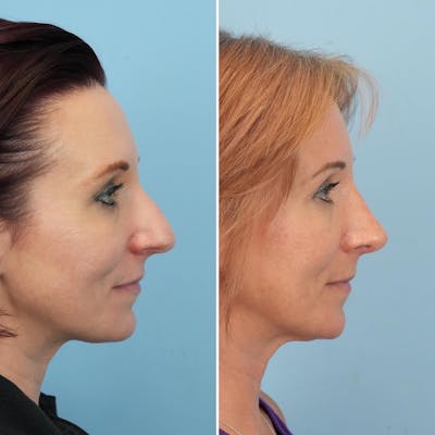 Rhinoplasty Before & After Gallery - Patient 338299 - Image 1