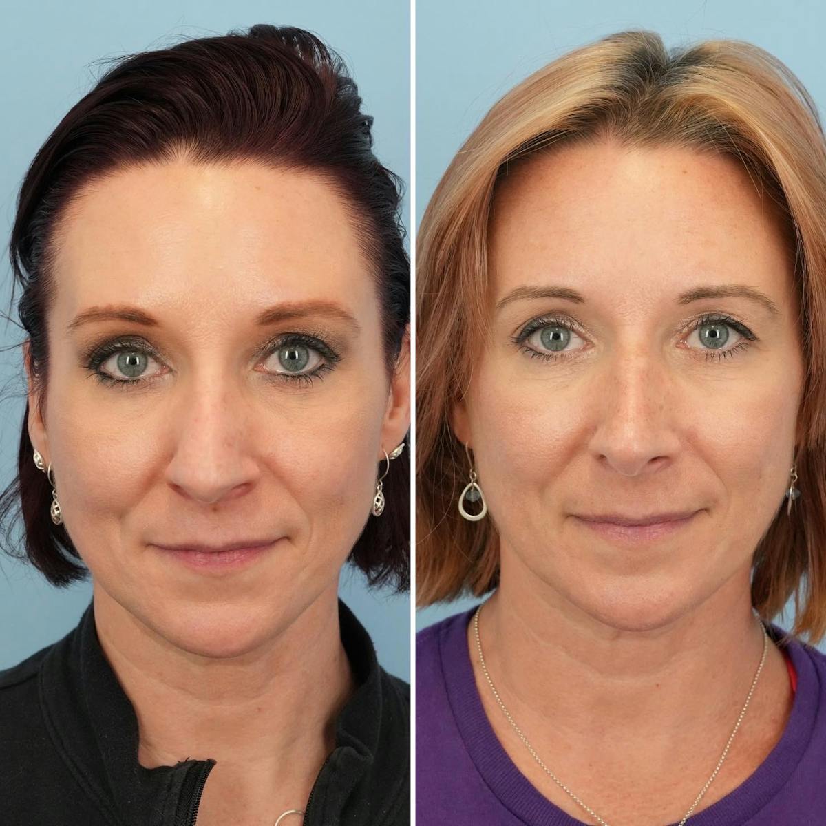 Rhinoplasty Before & After Gallery - Patient 338299 - Image 5