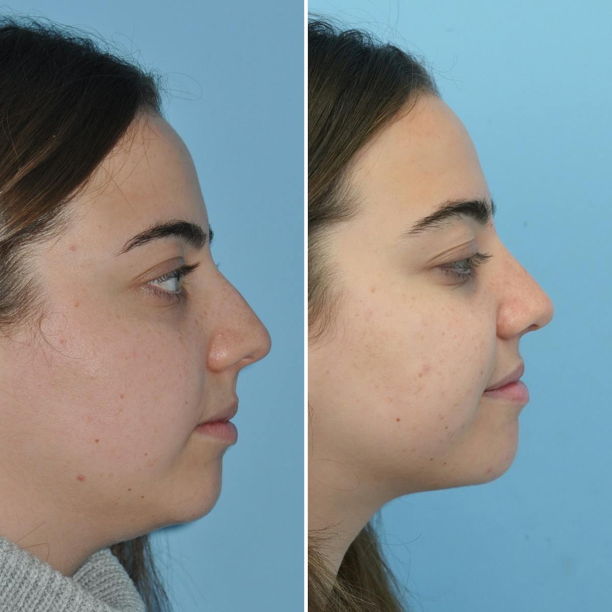Rhinoplasty Before & After Gallery - Patient 776574 - Image 1