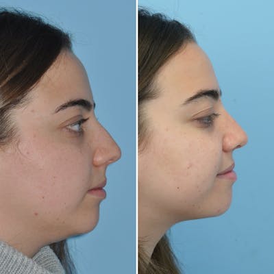 Rhinoplasty Before & After Gallery - Patient 776574 - Image 1