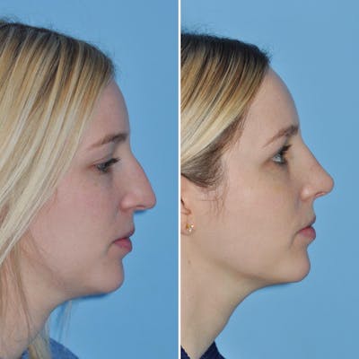 Rhinoplasty Before & After Gallery - Patient 217684 - Image 1