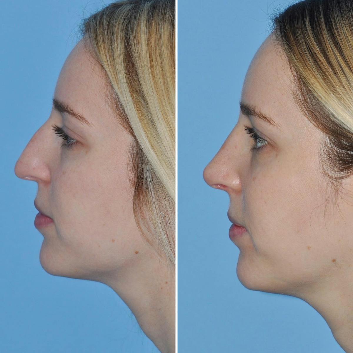 Rhinoplasty Before & After Gallery - Patient 217684 - Image 2