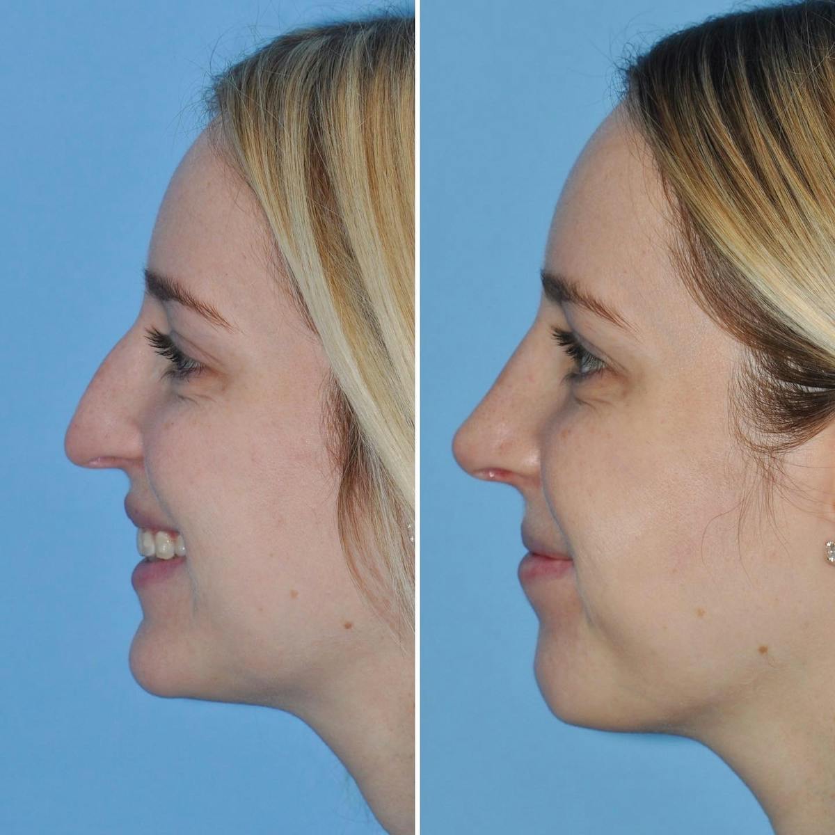Rhinoplasty Before & After Gallery - Patient 217684 - Image 5