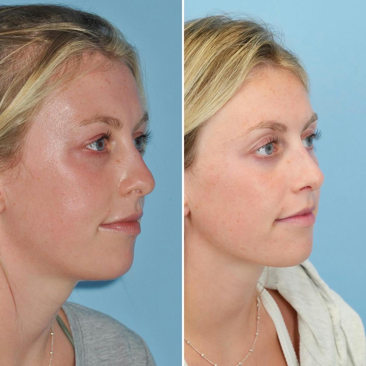 Rhinoplasty Before & After Gallery - Patient 547838 - Image 2
