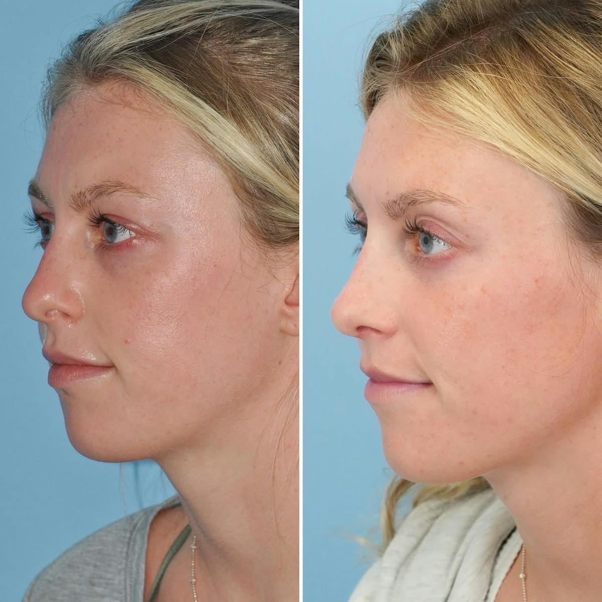 Rhinoplasty Before & After Gallery - Patient 547838 - Image 6