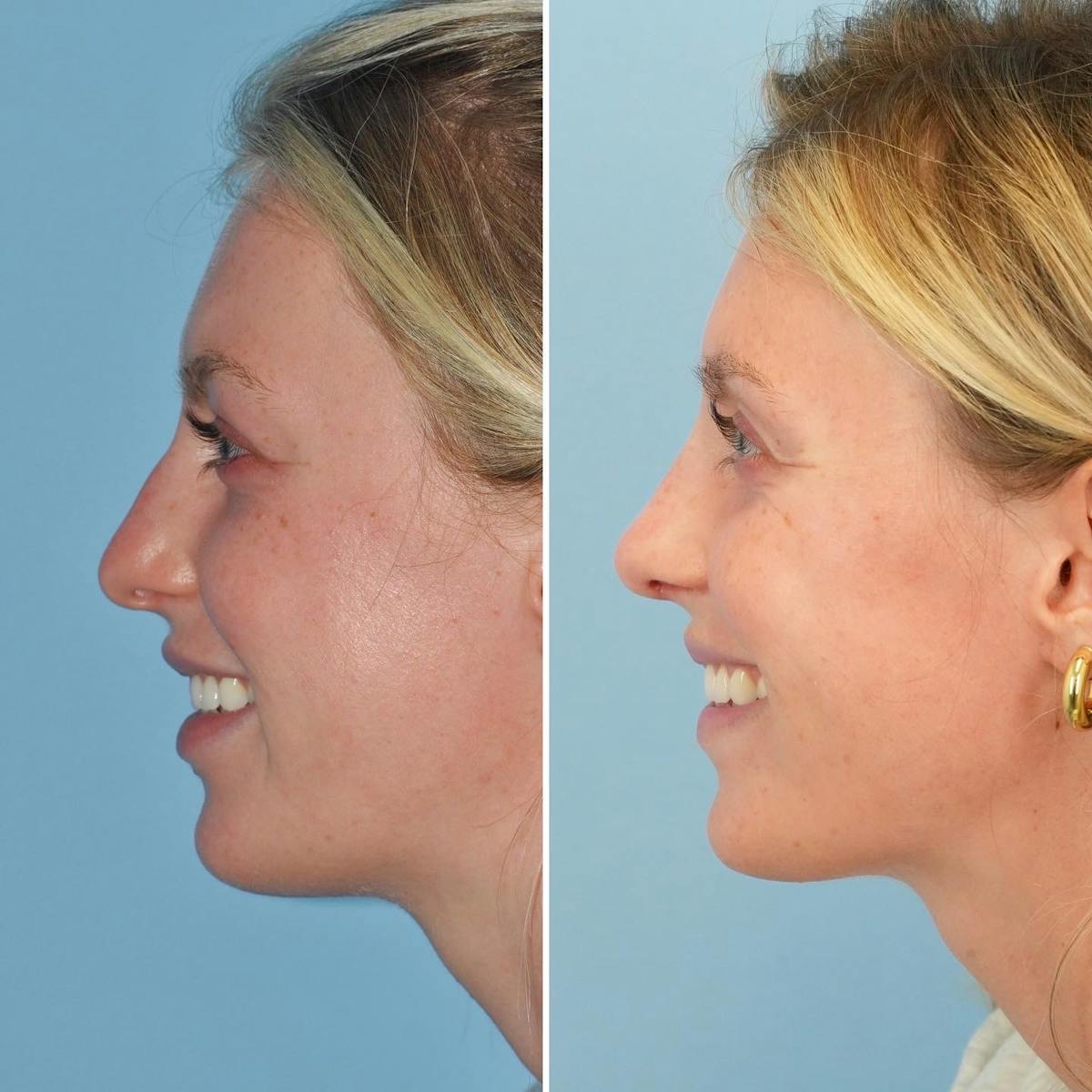 Rhinoplasty Before & After Gallery - Patient 547838 - Image 7