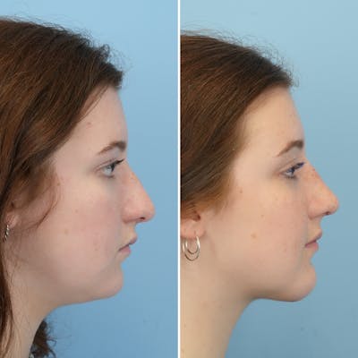 Rhinoplasty Before & After Gallery - Patient 372588 - Image 1