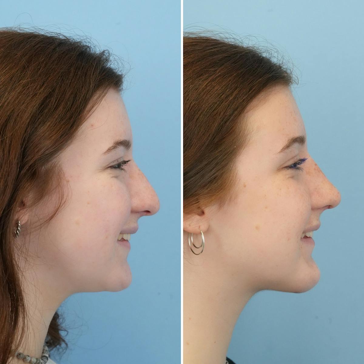 Rhinoplasty Before & After Gallery - Patient 372588 - Image 2