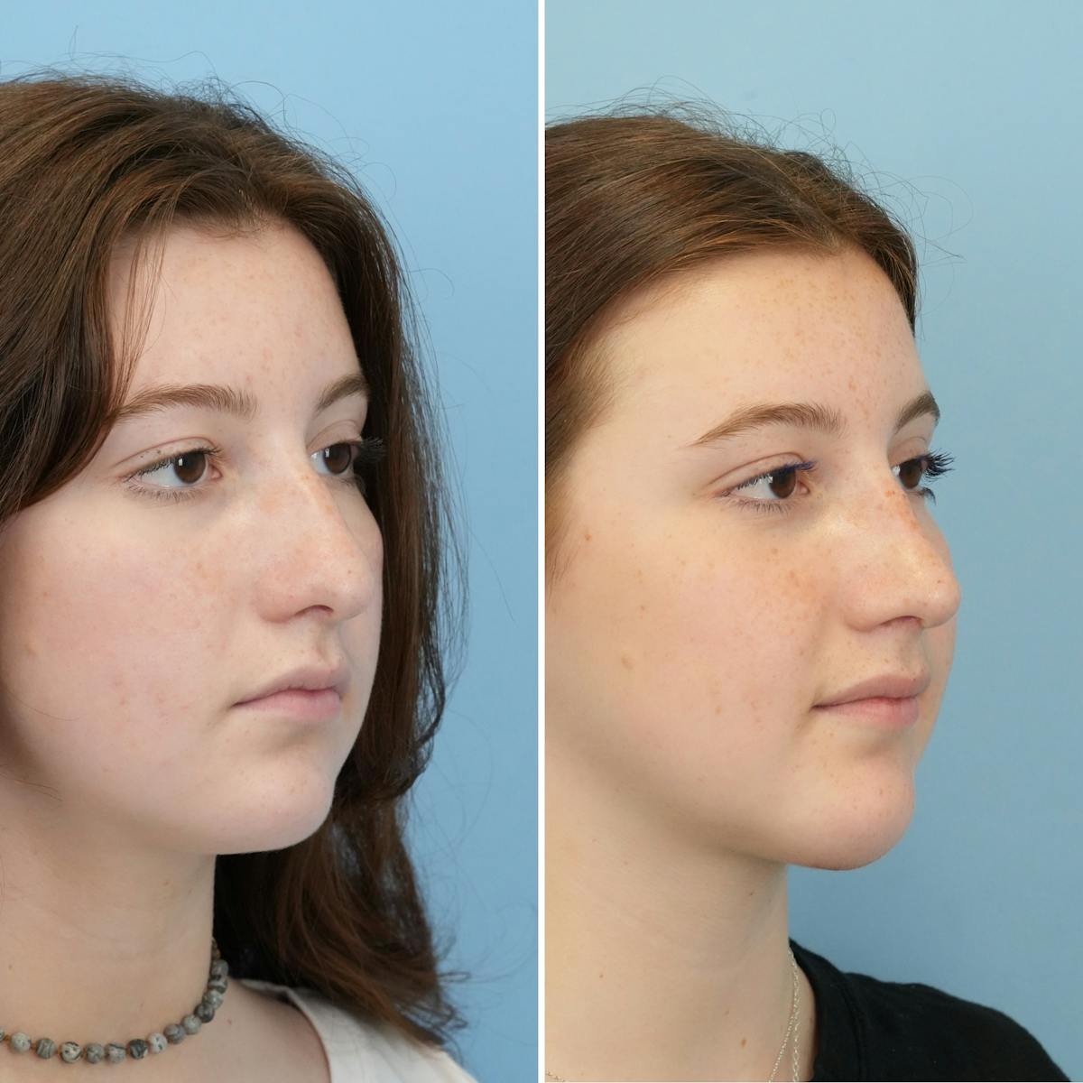 Rhinoplasty Before & After Gallery - Patient 372588 - Image 3
