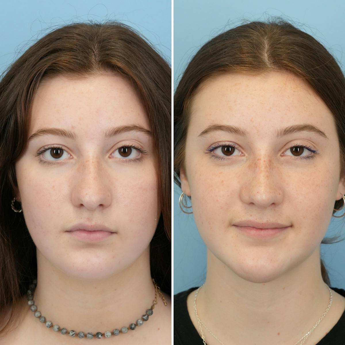 Rhinoplasty Before & After Gallery - Patient 372588 - Image 4