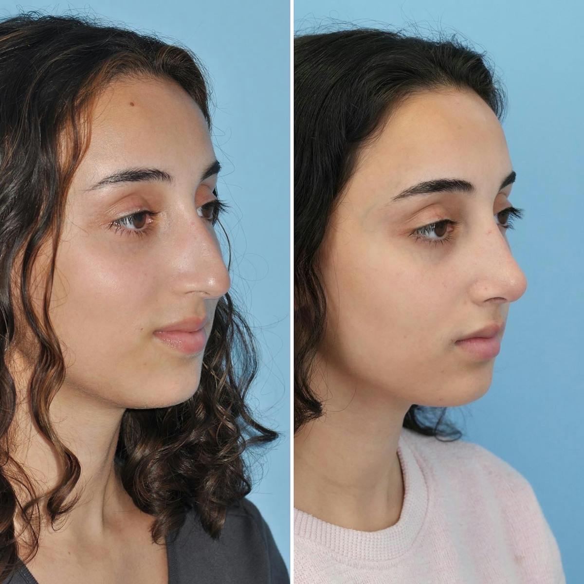 Rhinoplasty Before & After Gallery - Patient 946194 - Image 3