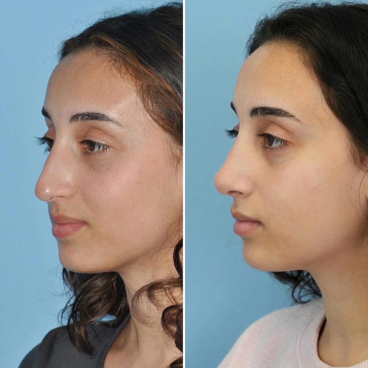 Rhinoplasty Before & After Gallery - Patient 946194 - Image 5