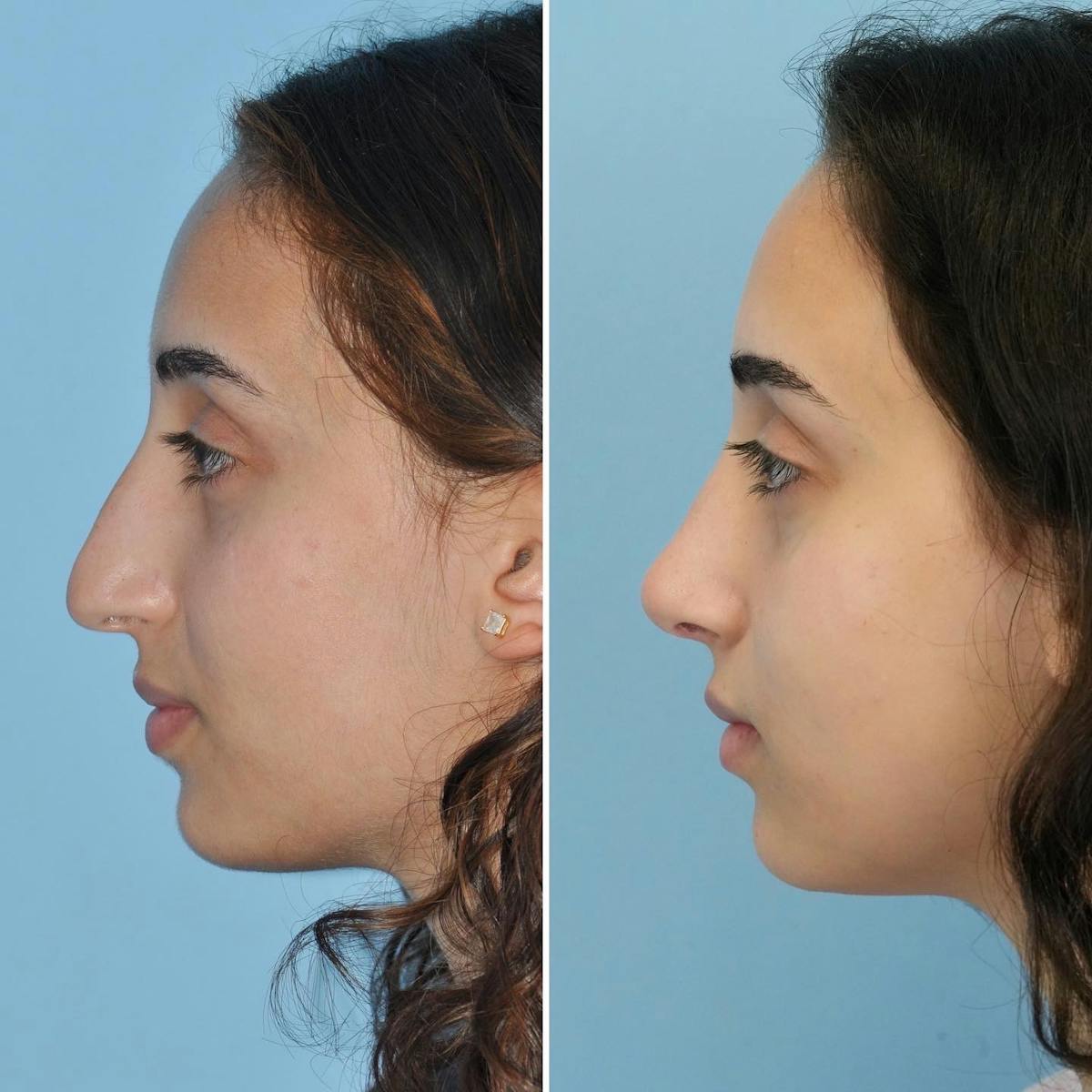 Rhinoplasty Before & After Gallery - Patient 946194 - Image 6